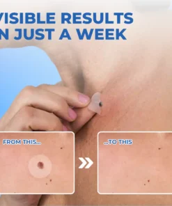Dobshow™ Moles & Warts Removing Skin Tag Patch