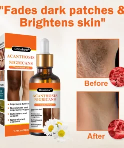 Dobshow® Acanthosis Nigricans Treatment Oil