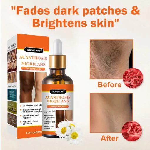 Dobshow® Acanthosis Nigricans Treatment Oil