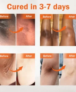 Dobshow® Acanthosis Nigricans Treatment Oil