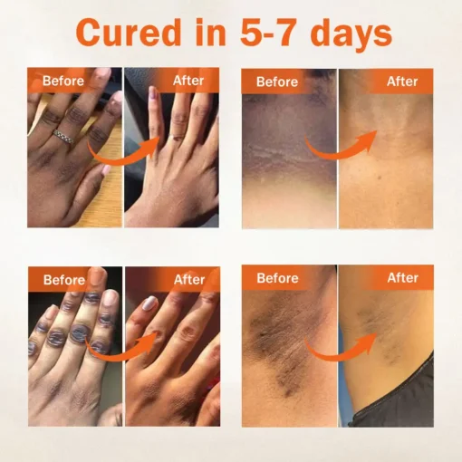 Dobshow® Acanthosis Nigricans Treatment Oil