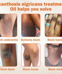 Dobshow® Acanthosis Nigricans Treatment Oil