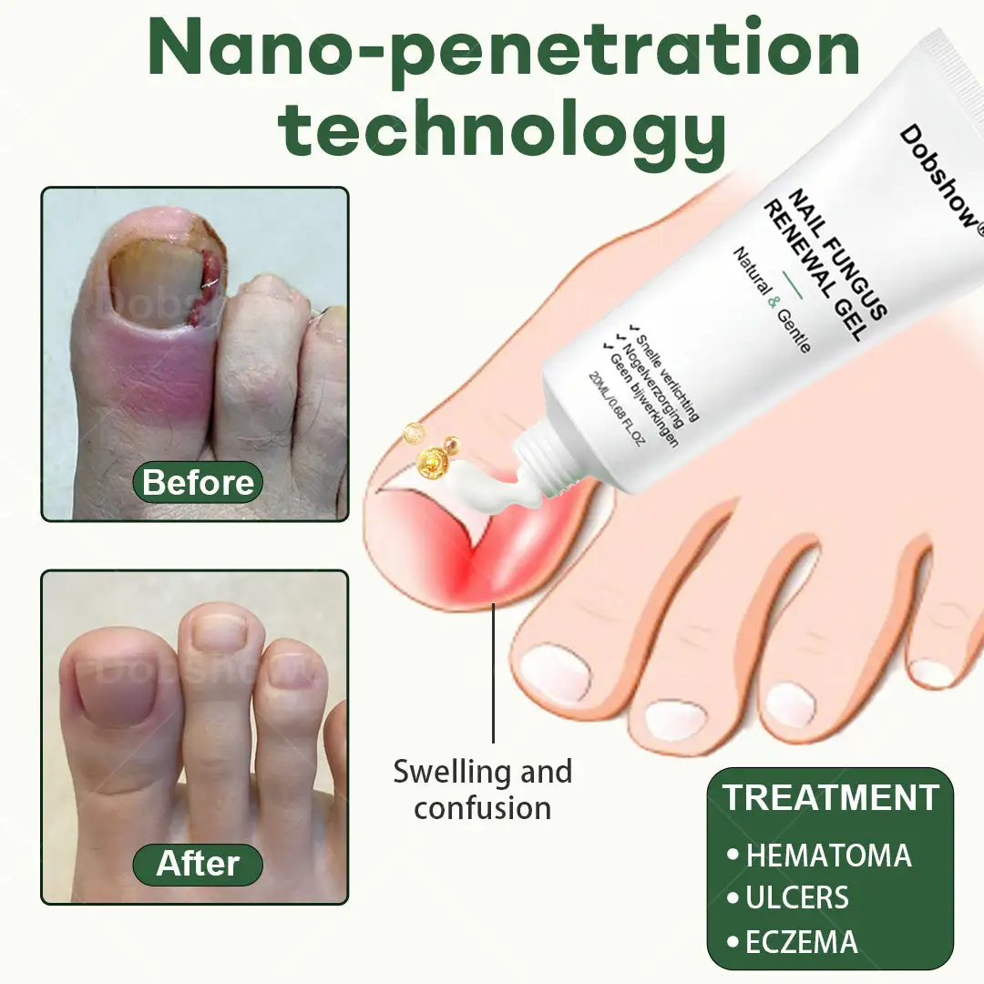 Dobshow® Nail Fungus Renewal Gel