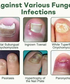 Dobshow® Nail Fungus Renewal Gel