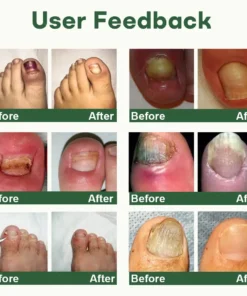 Dobshow® Nail Fungus Renewal Gel