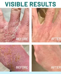 Dobshow® Probiotic + B 24-7 Moisture Eczema Relief Cream