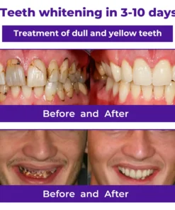 Dobshow® Dental Repair Mineral Powder Buy 1 Get 1 Free