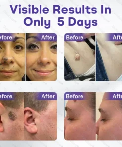 Dobshow® Wart and mole removal microneedle patch