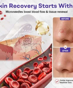 Dobshow® Wart and mole removal microneedle patch