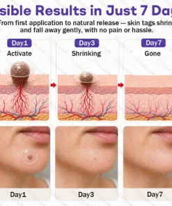 Dobshow® Wart and mole removal microneedle patch