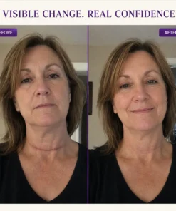 Dobshow® Allantoin Scar Gel