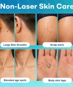 Dobshow® 7-Day Blemish Remover Pain-Free & Scar-Free Advanced Roller Pen for Skin Tags and Spots