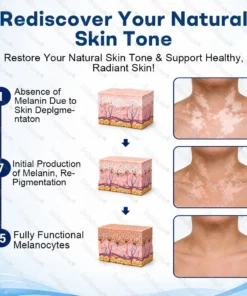 Dobshow® Advanced Piperine Vitiligo Repigmentation Spray