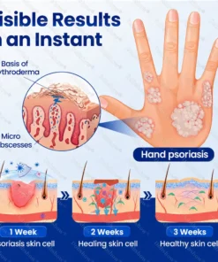 Dobshow® Advanced Psoriasis Relief Spray