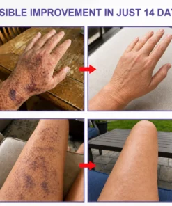 Dobshow® Dark Spot & Bruise Recovery Cream