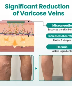 Dobshow® LegRenew Varicose Vein Patch