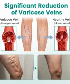Dobshow® LegRenew Varicose Vein Patch