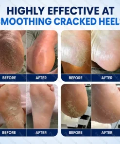 Dobshow® 2% Salicylic Acid Callus & Cracked Heel Spray