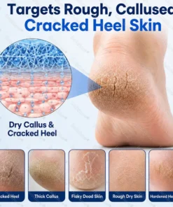 Dobshow® 2% Salicylic Acid Callus & Cracked Heel Spray