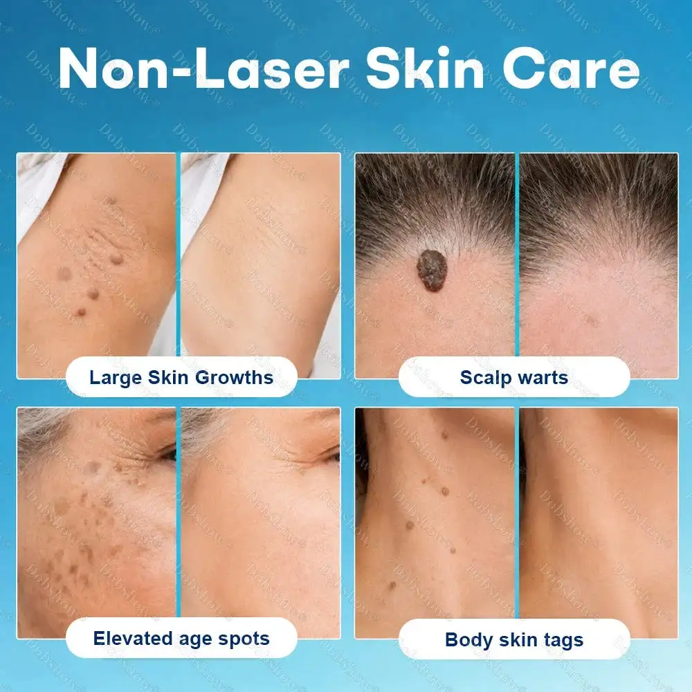 Dobshow® 7 -Day Wart & Blemish Remover