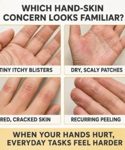 Dobshow® Dyshidrotic Eczema Relief Cream