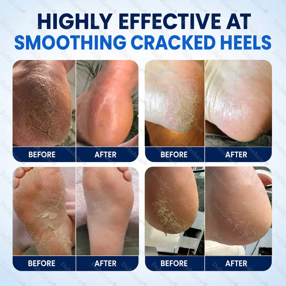 Dobshow® Medical-Grade 2% Salicylic Acid Callus & Cracked Heel Repair Spray