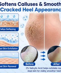Dobshow® Medical-Grade 2% Salicylic Acid Callus & Cracked Heel Repair Spray