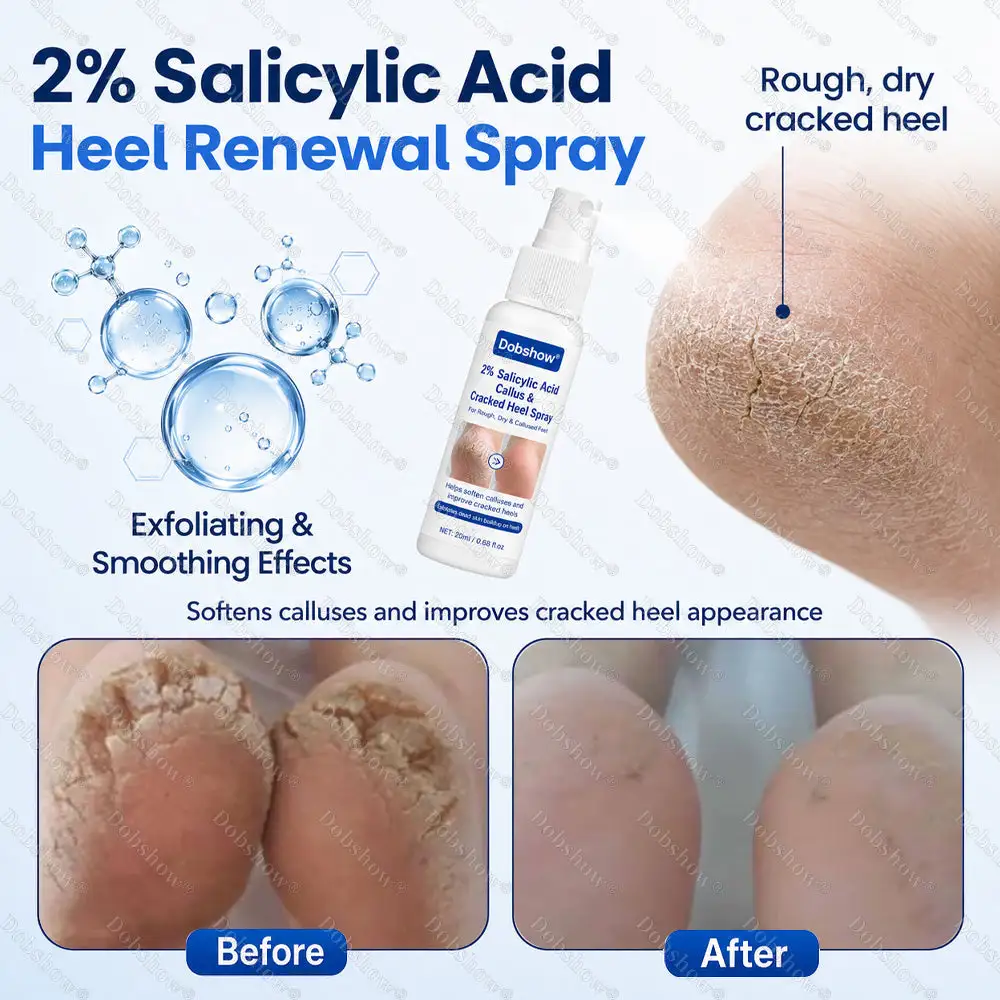 Dobshow® Medical-Grade 2% Salicylic Acid Callus & Cracked Heel Repair Spray