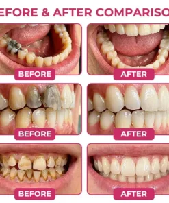 Dobshow® DenPerm Cavity-Repair Advanced Enamel Filling Gel