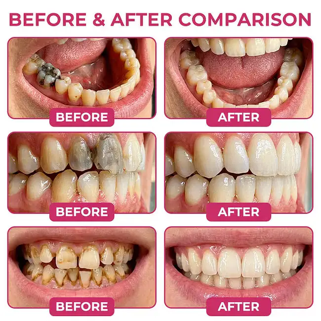 Dobshow® DenPerm Cavity-Repair Advanced Enamel Filling Gel