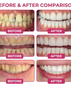 Dobshow® DenPerm Cavity-Repair Advanced Enamel Filling Gel