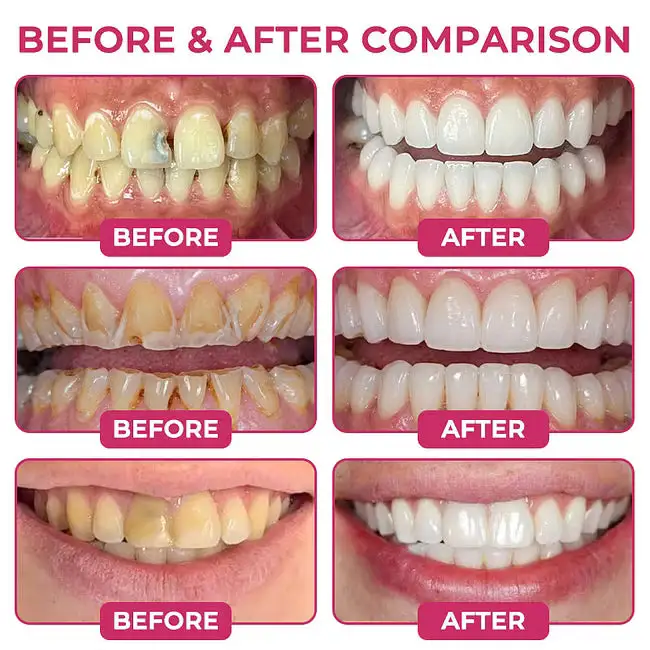 Dobshow® DenPerm Cavity-Repair Advanced Enamel Filling Gel