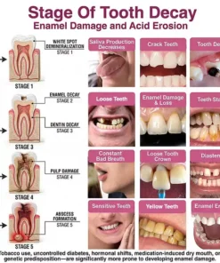 Dobshow® DenPerm Cavity-Repair Advanced Enamel Filling Gel